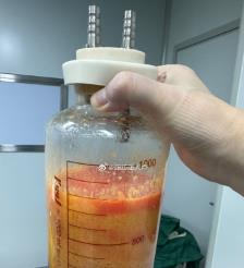 舟山水动力吸脂手术要做多久？